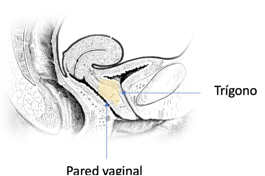 ¿Qué es el Rejuvenecimiento Vaginal y en Qué Consiste Exactamente? 